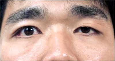 [新聞]  眼瞼下垂像沒睡飽 手術可解決困擾