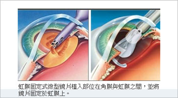 [新聞]  植入微型鏡片 屈光手術新選擇