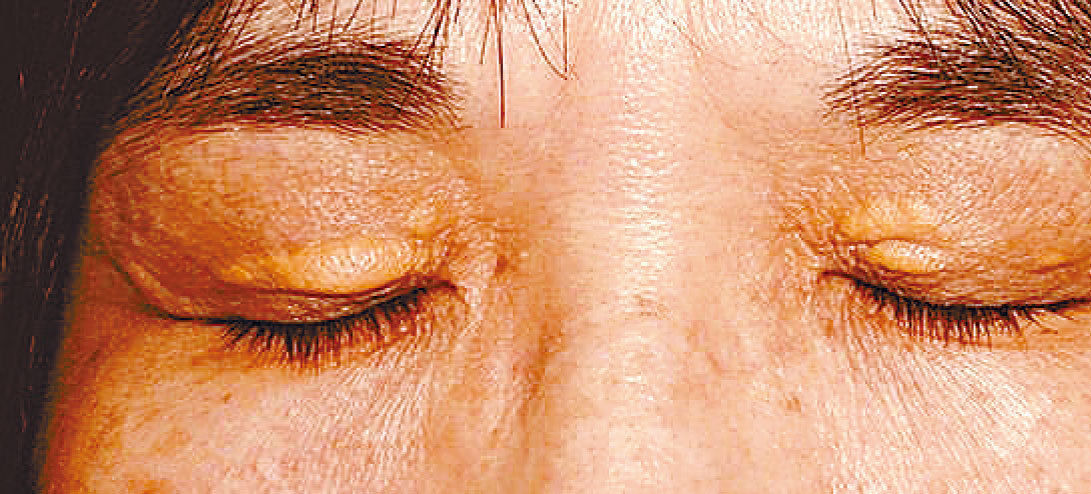 眼頭上的黃色腫塊影響美觀怎麼辦？了解“眼瞼黃斑瘤”